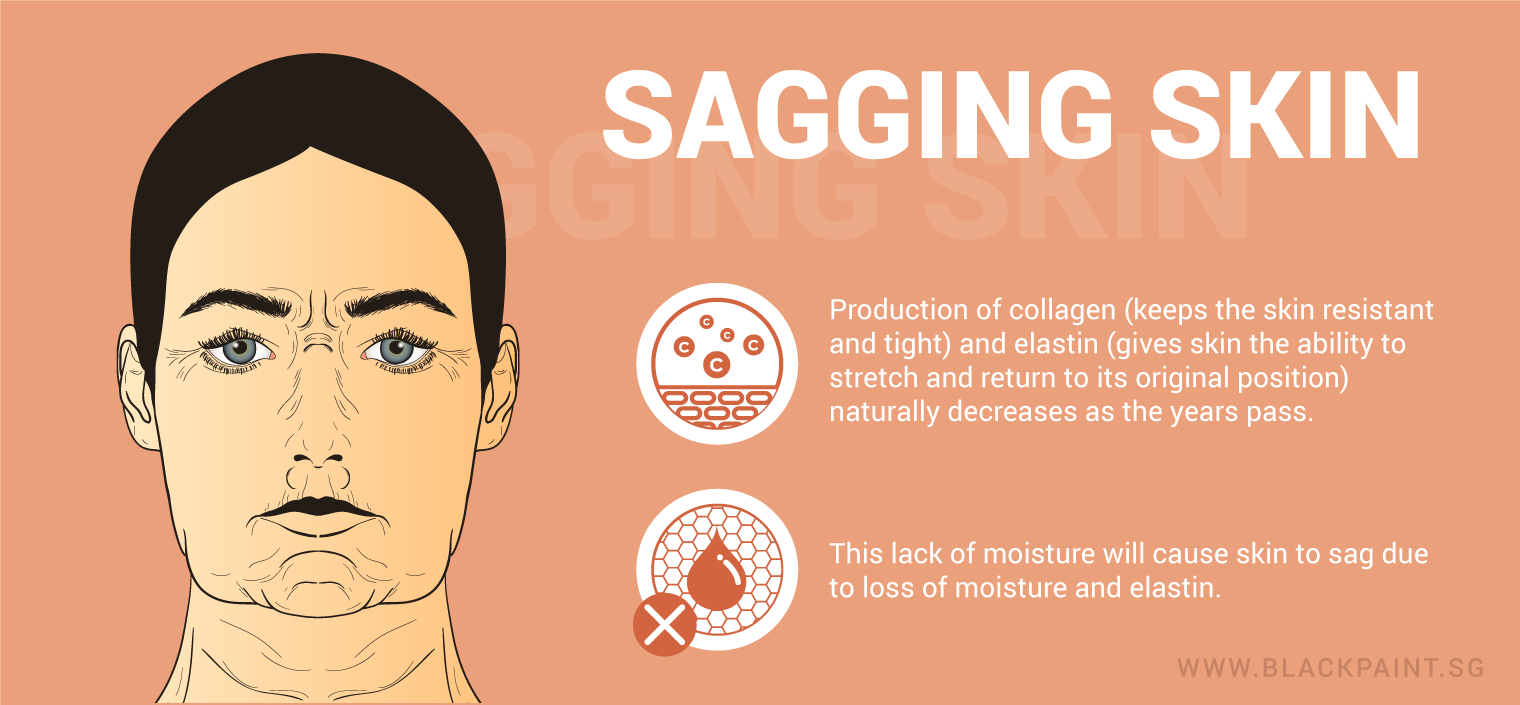 illustration of sagging skin as the result of reduced collagen and moisture in the skin