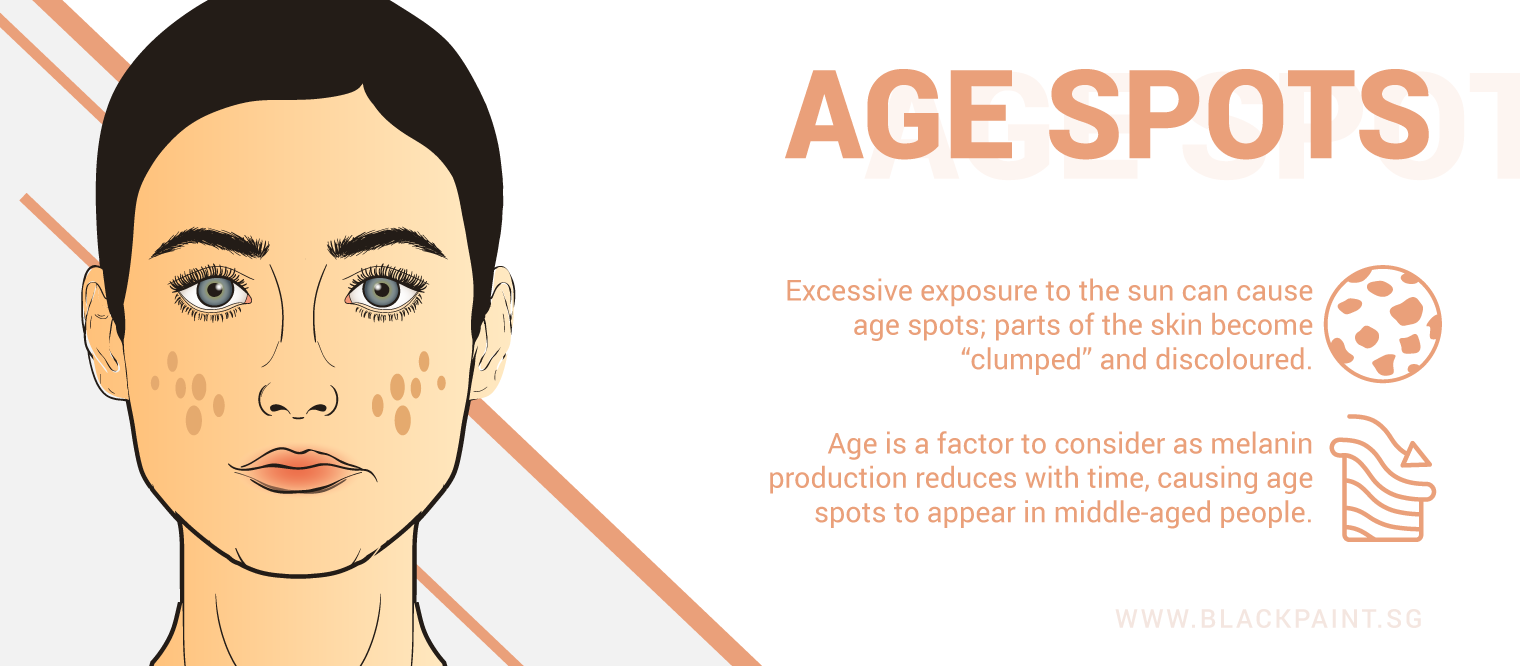 illustration of age spots can happen due to natural aging process, or excessive exposure to sun rays.