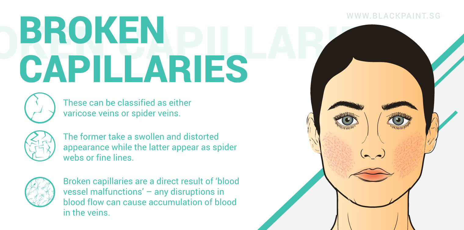 illustration of broken capillaries can be either varicose veins or spider veins.