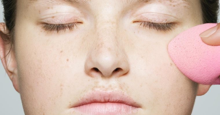 Questions about hyperpigmentation answered