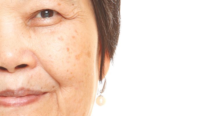hyperpigmentation and age spots on a woman's face
