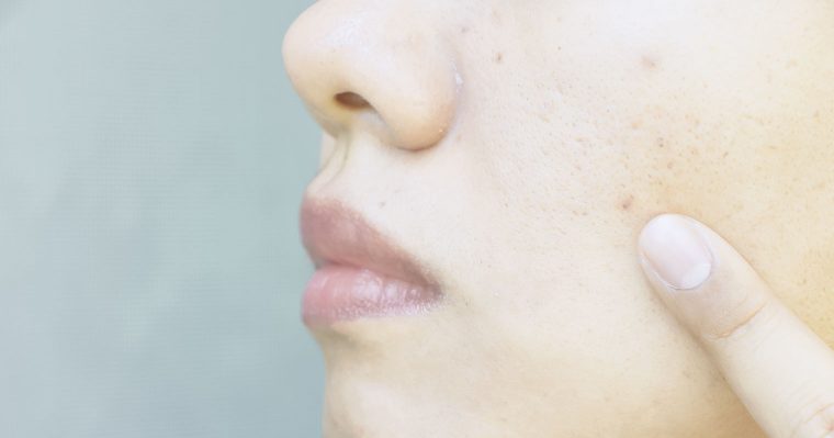 close up wide pores on oily face skin, nose and mouth which have problem skin of asia woman by woman use finger point focus problem on face have copy space on left side