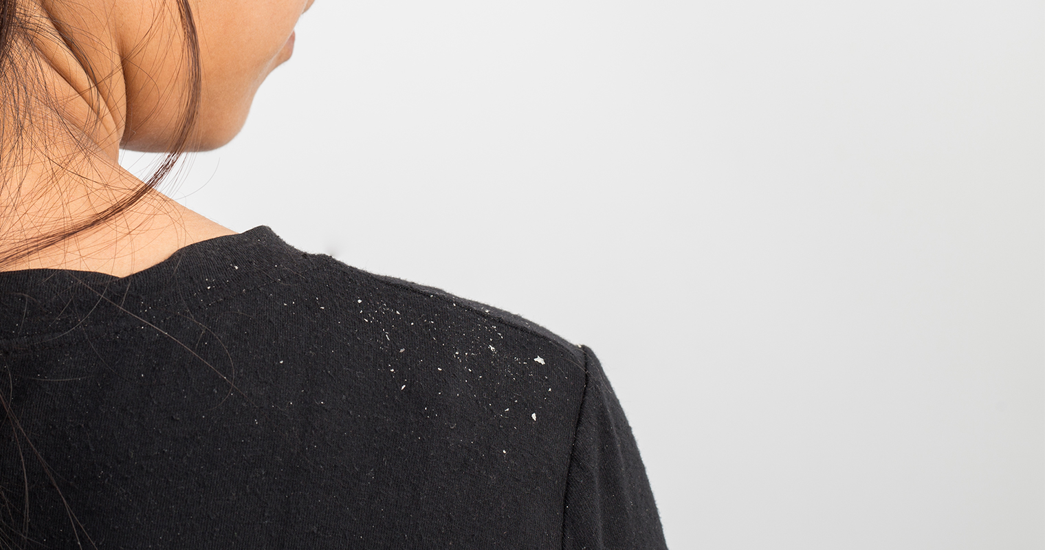 dandruff on the shoulder of a girl wearing black shirt